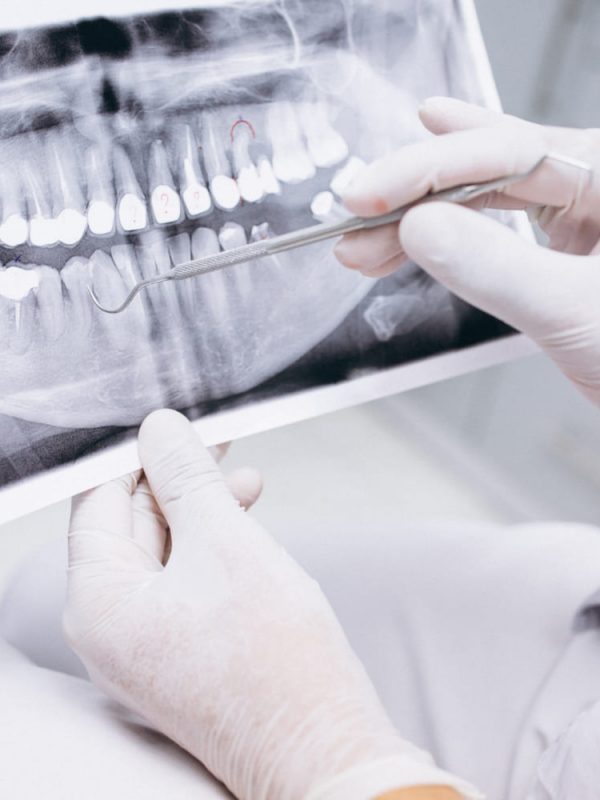 x-ray-of-teeth